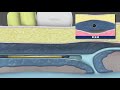 下肢静脈瘤に対する血管内焼灼術　|　杉並区の井上医院