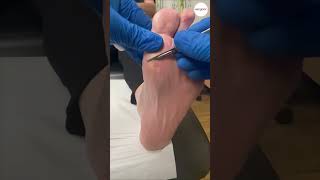 Callus On Forefoot Removal