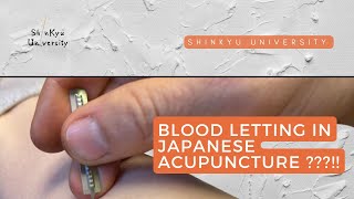 Blood letting in Japanese acupuncture???!!