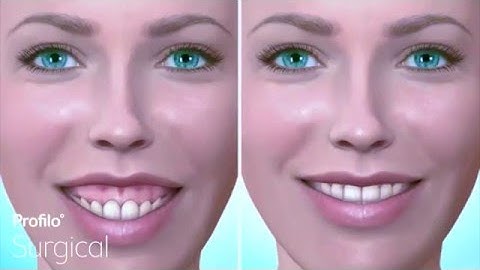 Le Fort I | Gummy Smile & Upper Jaw Reduction