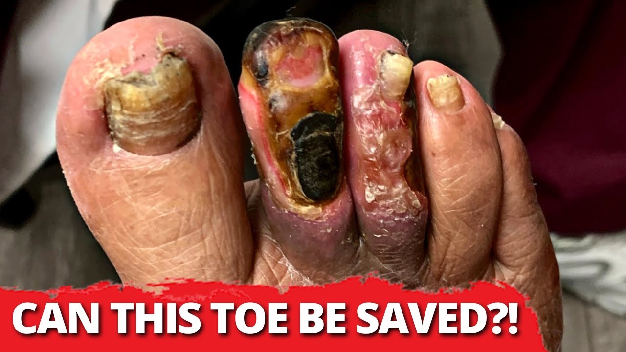 Can This Diabetic Infected Toe Be SAVED By Oxygen Therapy?? + Dramatic Nail Cutting!