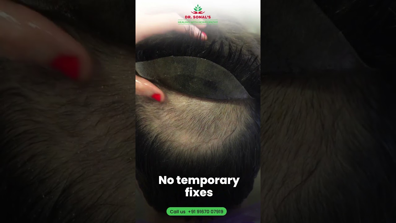 Stop Hair Loss Naturally | Hair Loss Treatment in Mumbai | Dr Sonal’s Healing with Homeopathy