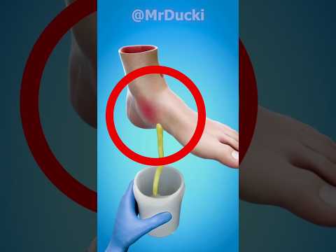 هیچوقت یه تاول رو نترکون