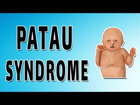 Video: Patau Syndrome - - Causes, Symptoms And Treatment