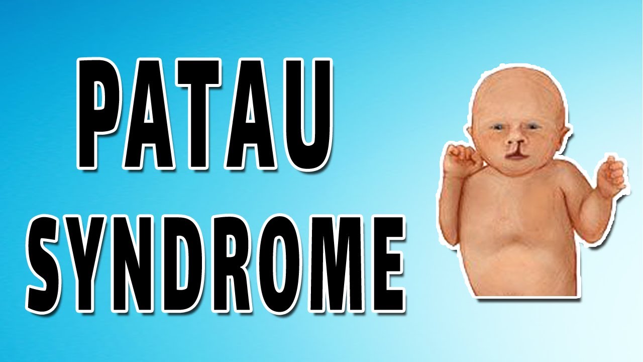 Patau syndrome physical characteristics