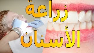 زراعة الأسنان | ماذا تعرف عنها | الموسوعة العلمية