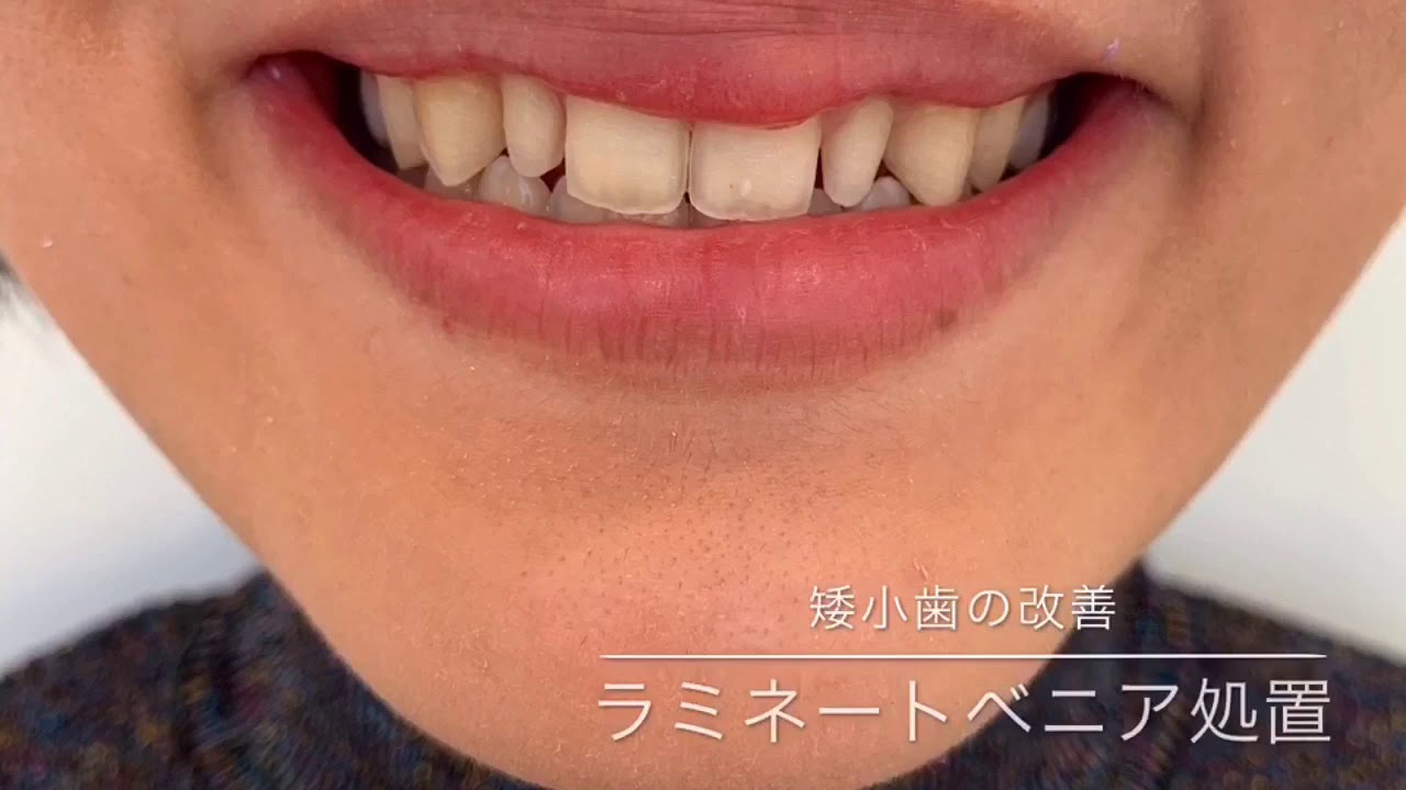 生まれつき歯が小さい 矮小歯 ラミネートベニアで歯の形 色を改善 Youtube 生まれつき歯が小さい 矮小歯 ラミネートベニアで歯の形 色を改善 Youtube