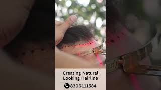 Natural Hairline In Hair Transplant Surgery Get A Good Hairline Skinaa Clinic 