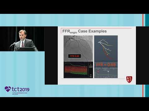 FFRangio Compared to FFR – Clinical Data and Subgroup MVD Analysis