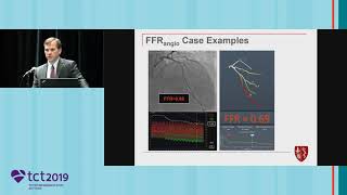 FFRangio Compared to FFR – Clinical Data and Subgroup MVD Analysis