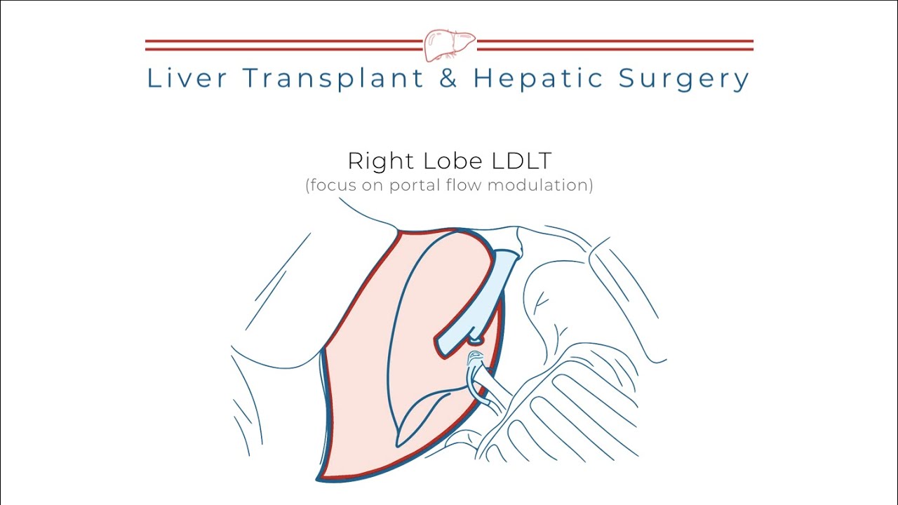 #8 Right Lobe LDLT (focus on portal flow modulation) - YouTube