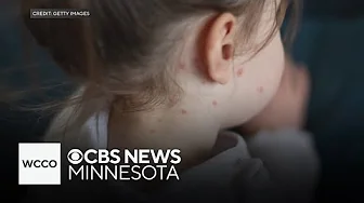 More measles cases reported in Minnesota