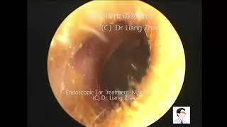 Endoscopic ear treatments by Dr Zhao EP. 9 - 05/03/2020