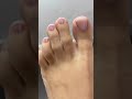 Pretty nails or hairy toes laserhairremoval