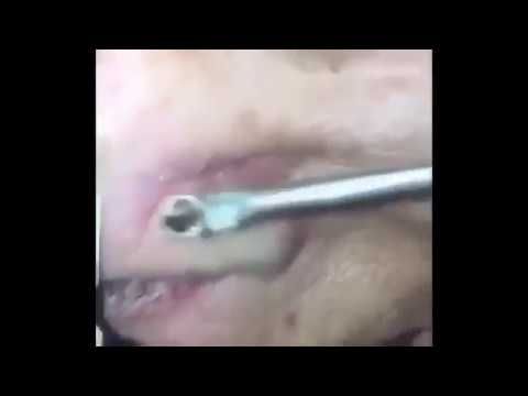 THE MOST SATISFYING GIANT BLACKHEADS REMOVAL APRIL 