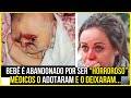 Bebê é ABANDONADO por ser “HORROROSO” e depois de adotado  é assim que ele está hoje!