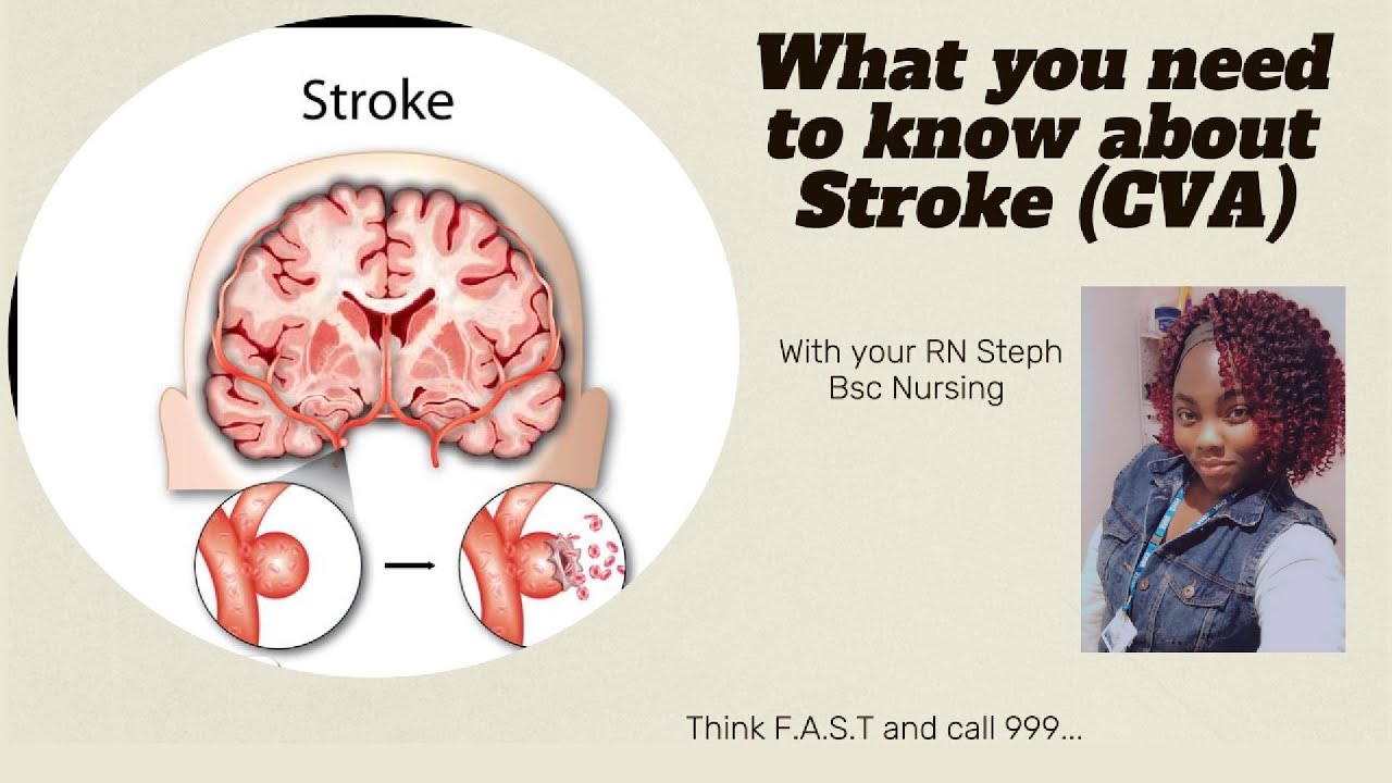 What you need to know about stroke - YouTube