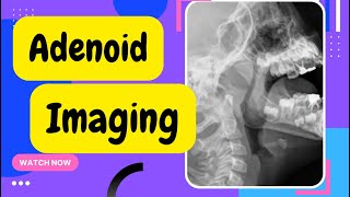 Adenoid imaging |X-ray Adenoids |X Ray of Adenoid Lateral view of Nasopharynx| Lateral neck x-ray