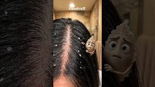 Dandruff Itna Kyun Badh Raha? 😳 Stop This FAST!