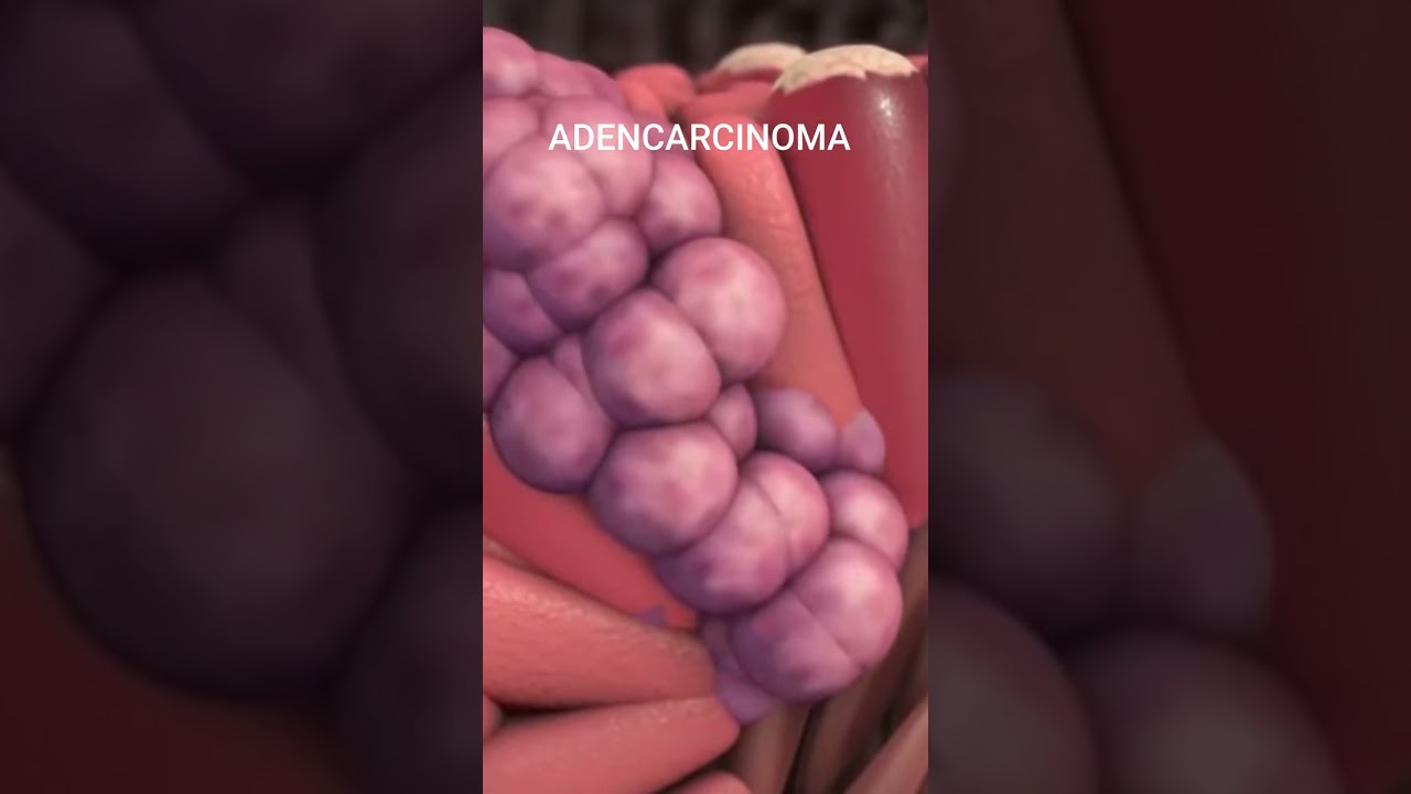 Esophageal Cancer Cells Growth and Spread Revealed Surprising!