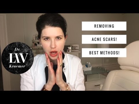 Best methods how to treat acne scars- (by Dr Liv Kraemer)