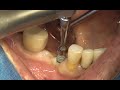 Simple implantation with minimally invasive surgery