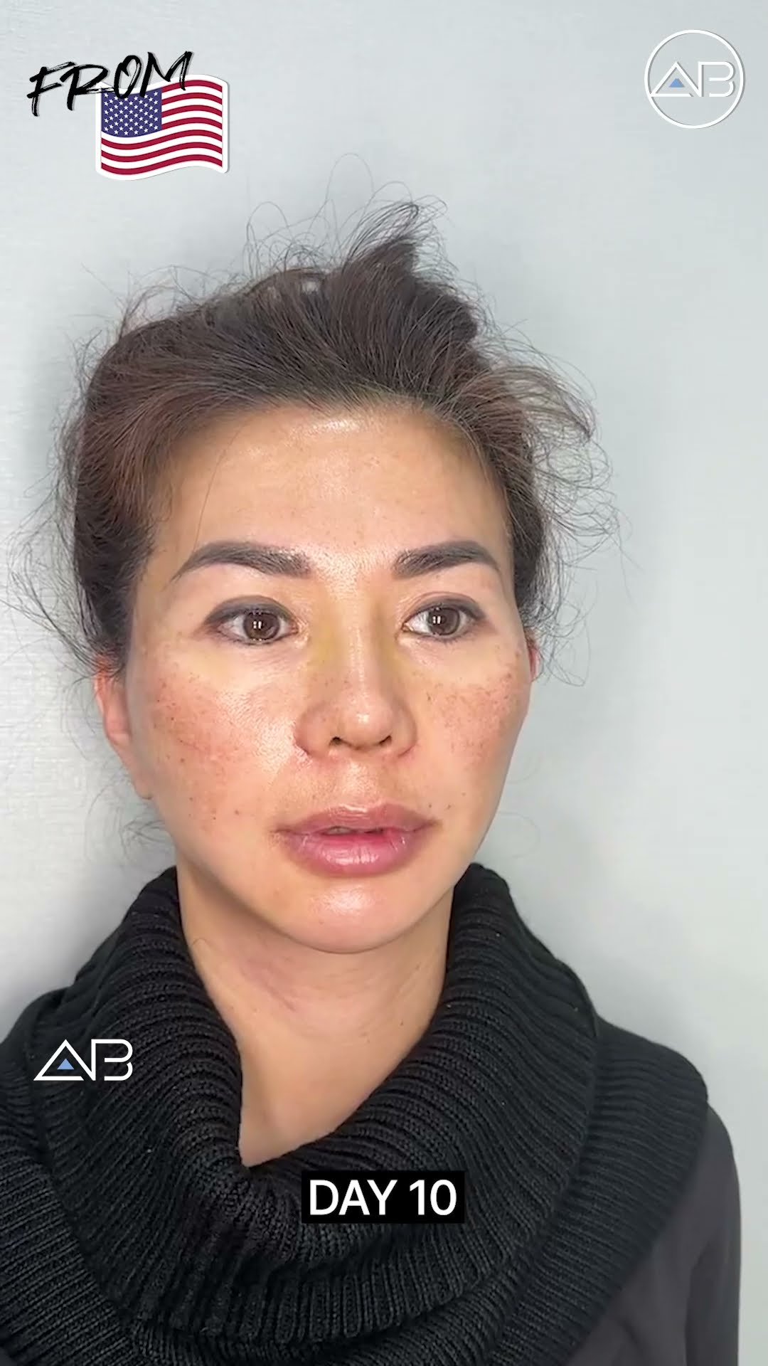 Rejuvenate Your Appearance: Stunning Facelift Results Revealed! #shorts