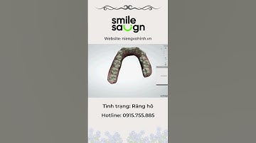 Phác đồ niềng răng - Smilesalign Việt Nam