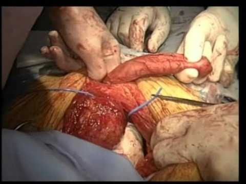 Prophylactic Prepubic Urethrectomy During Radical Cystoprostatectomy