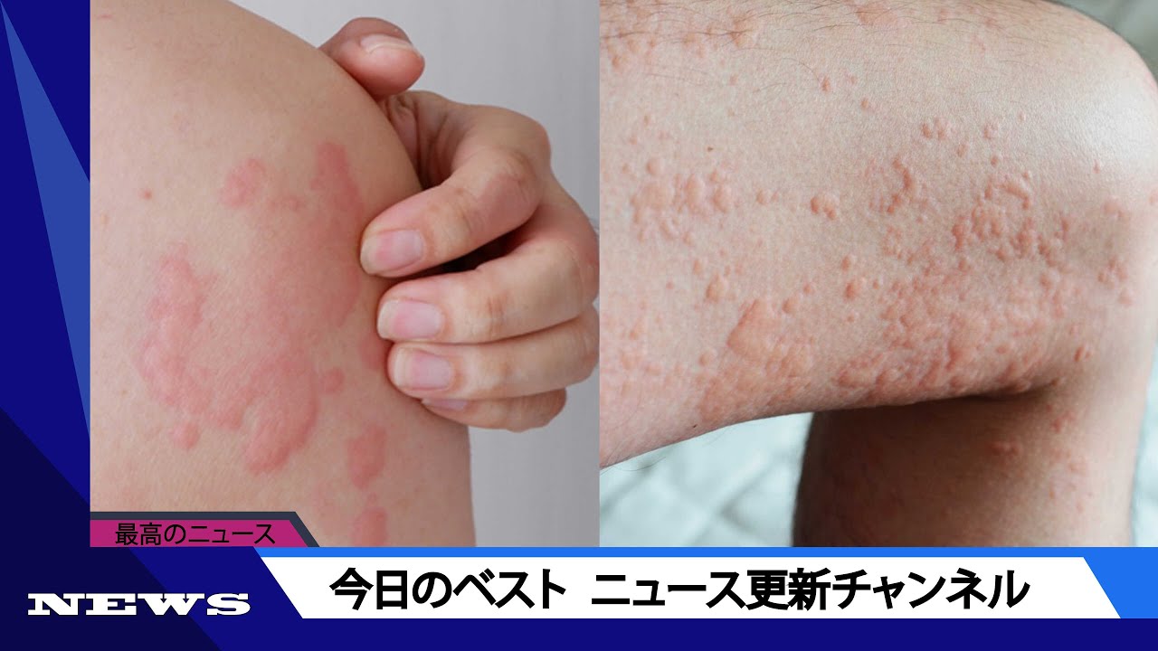 はしか 一度感染 _ はしか 空気感染 – 麻しんQ&A I 麻しんの基礎知識 – YBWUV