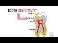 Theories of dentin sensitivity hypersensitivity