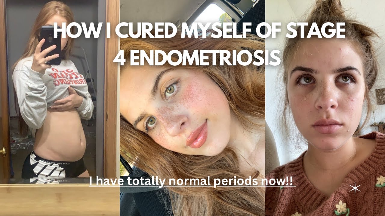 STAGE 4 ENDO SYMPTOMS (+ Life after surgery and how I cured my periods!!)