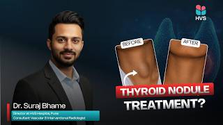 Thyroid Nodule Treatment Without Surgery | Radiofrequency Ablation (RFA) Explained | Dr. Suraj Bhame
