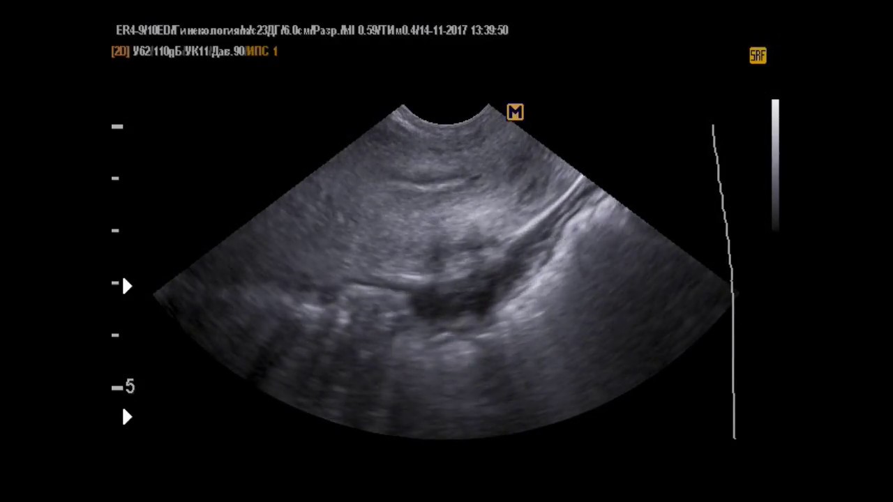 Эндометриоз видно на узи. Ретроцервикальный аденомиоз. Ретроцервикальный эндометриоз на УЗИ.