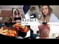 Sunburn + London Food Markets | Weekly Vlog #190