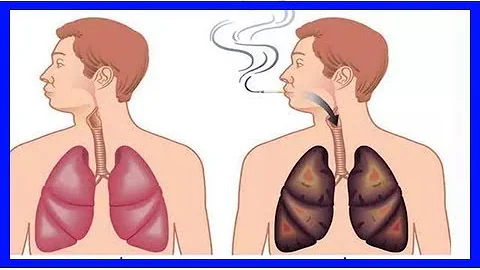 戒煙後，肺部還能恢復正常嗎，需要多久？ - 天天要聞