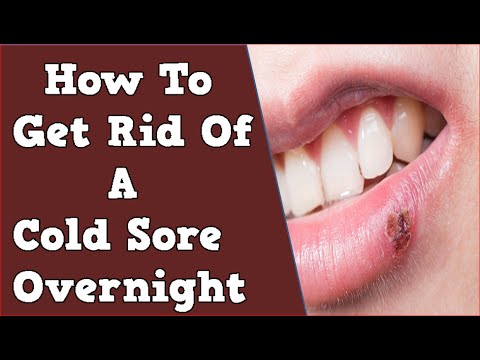 How To Get Rid Of A Cold Sore Overnight, Cold Sore, How To Stop Cold Sores, Cold Sore Lip - YouTube