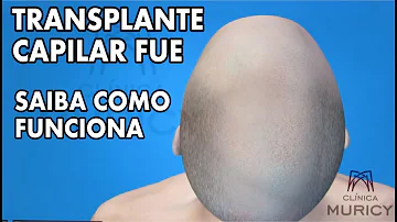Como é feito o implante de cabelo?