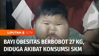 Bayi Berusia 16 Bulan Berbobot 27 Kg, Diduga Akibat Sering Minum Susu Kental Manis Liputan 6