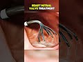 Heart Mitral Valve Treatment|3D ANIMATIONS| #MitralValveTreatment #MitralValveRepair #fyp