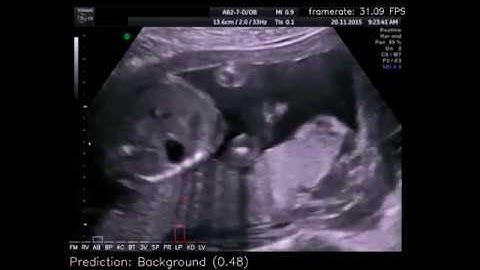 Automatic real-time fetal standard scan plane detection using convolutional nets.