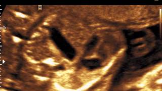 Med2000Eco Ernia Diaframmatica