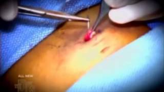 Cosmetic Belly Button Surgery Cosmetic Belly Button Surgery