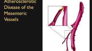 CTA of the Abdominal Aorta Branches: Select Pathologies Part 1