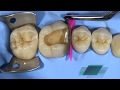 Cusp Build-Up of a Molar with G-ænial™ Universal Injectable