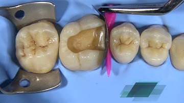 Cusp Build-Up of a Molar with G-ænial™ Universal Injectable