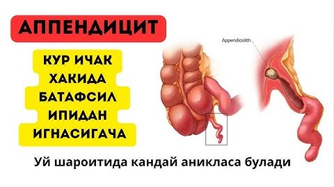 АППЕНДИЦИТ, КУР ИЧАК ХАКИДА БАТАФСИЛ МАЛУМОТ