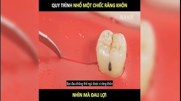 Nhổ một chiếc Răng Khôn đau đến mức nào | LT Review