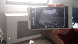 128 elements/R60 wireless convex probe with Android ultrasound software 20160405 105641