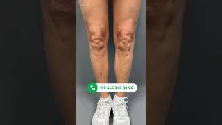 Wadenimplantat Woche 1: Schnelle Heilung!